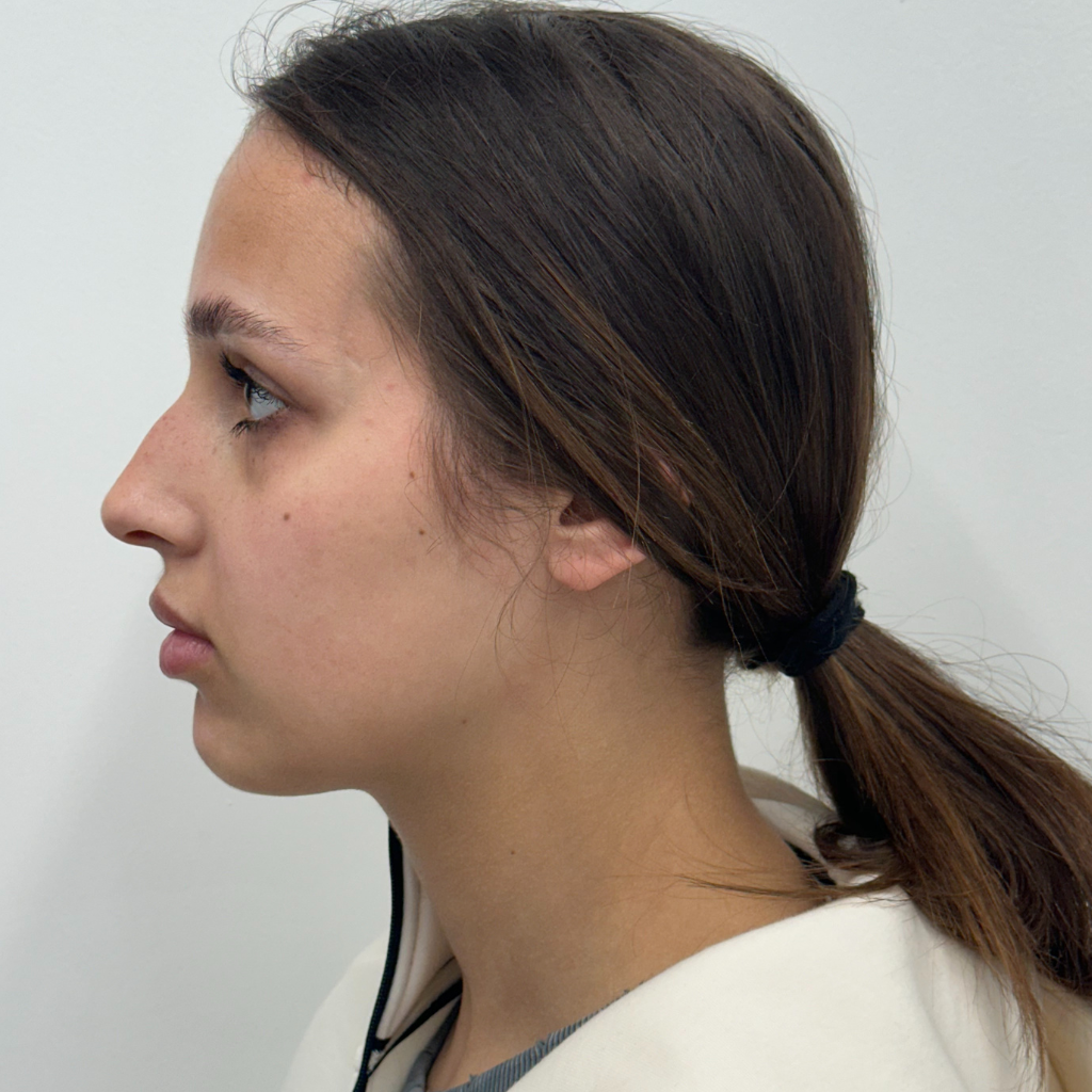 Профил на млада жена преди ринопластика – видима лека гърбица на носа и по-изпъкнал носен профил.