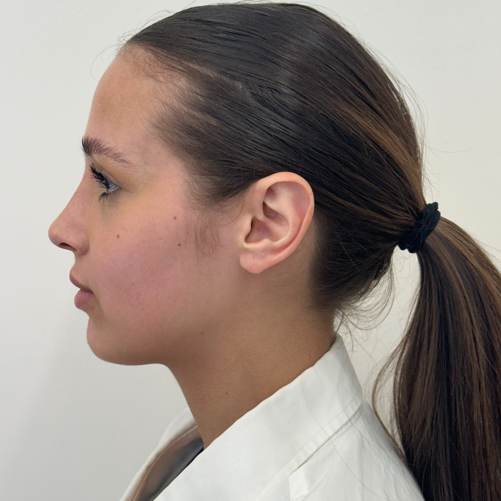 Профил на същата млада жена след ринопластика – изправен и по-фин носов контур с хармонизиран профил на лицето.