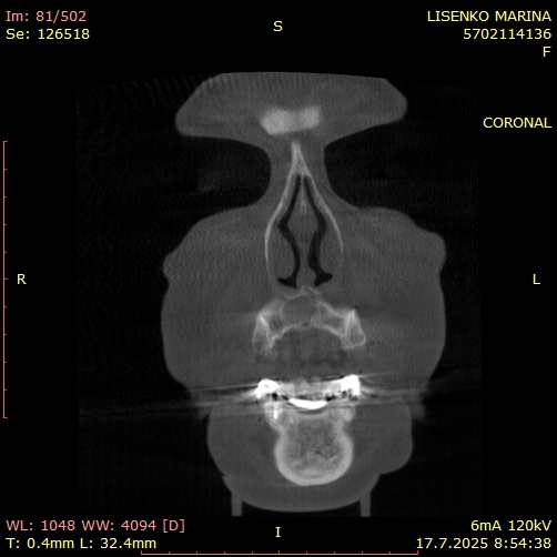 Коронален срез, изобразяващ симетрията и обема на кистата в предна максиларна зона