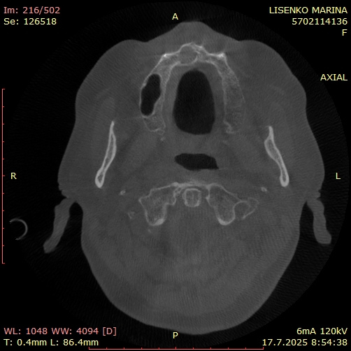 Axial срез от КБКТ, показващ киста в областта на назопалатиналния канал