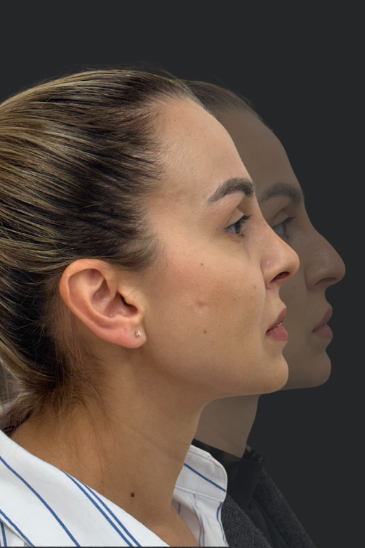 Профил от дясната страна на същата пациентка преди и след ринопластика – сравнение на извивката на носа и контура на лицето.
