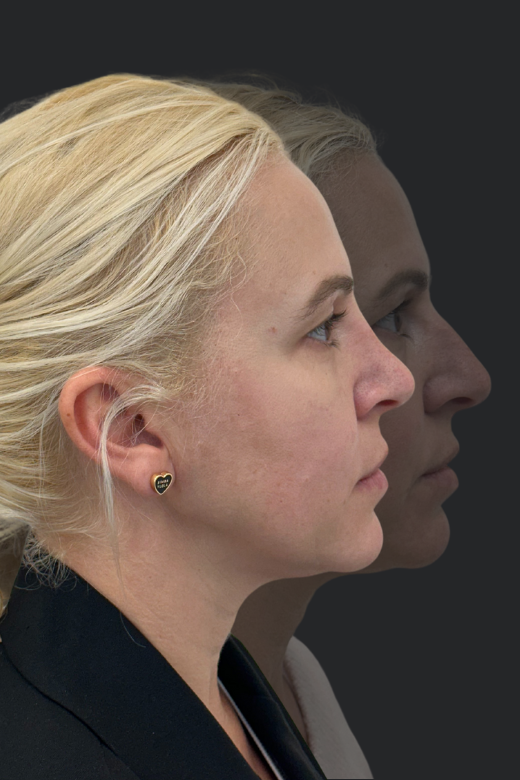 Профил от дясната страна на същата пациентка преди и след ринопластика – сравнение на извивката на носа и контура на лицето.