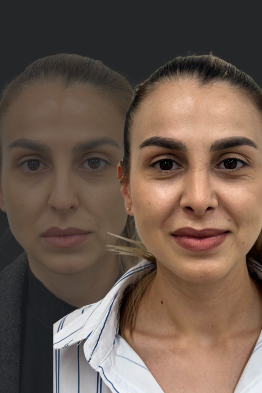 Фронтална снимка на млада жена преди и след ринопластика – ясно личи изразената разлика във формата на носа и лицевата симетрия.