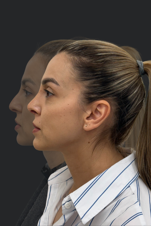 Профил на млада жена преди и след ринопластика – визуализирана е промяната във формата на носа отляво надясно.