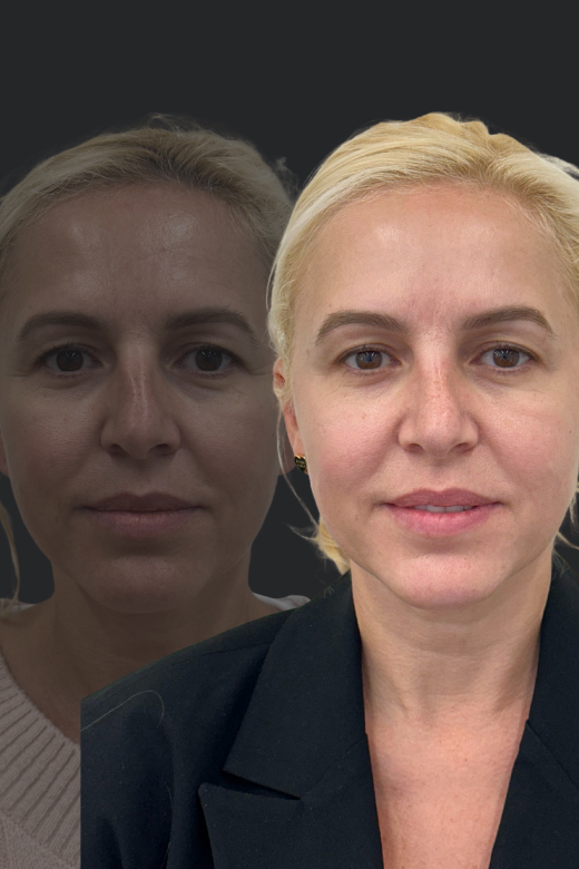 Фронтален изглед на същата блондинка преди и след ринопластика – подобрена симетрия и по-нежен вид на носа.