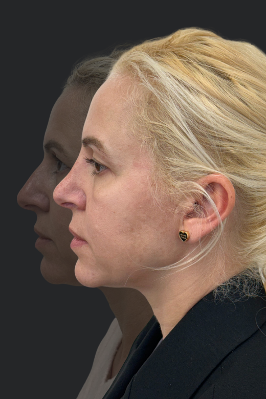 Профилна снимка на блондинка преди и след ринопластика – подчертани промени в гърба на носа и линията на профила.