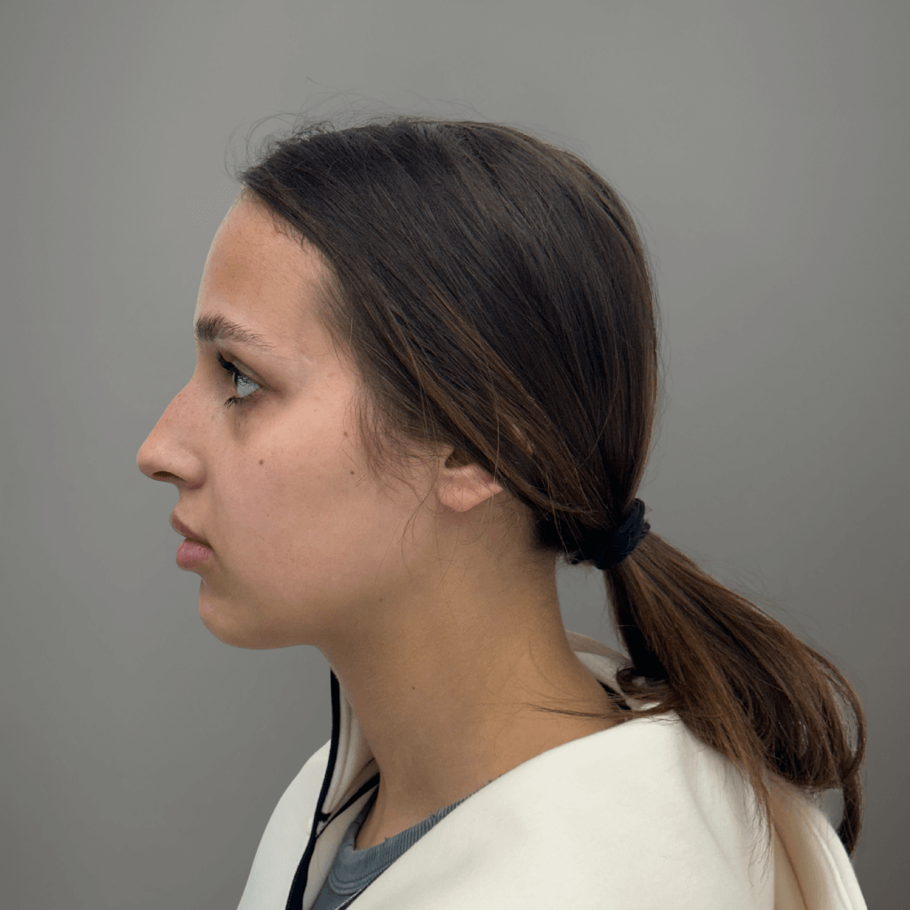 Профилна снимка отляво на пациент след ринопластика, показваща подобрена форма и деликатен контур на носа, извършена в клиника Aesthetico