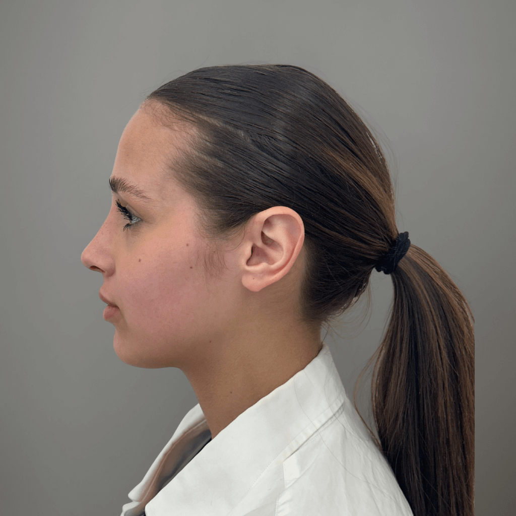 Профилна снимка отляво на пациент след ринопластика, показваща подобрена форма и деликатен контур на носа, извършена в клиника Aesthetico