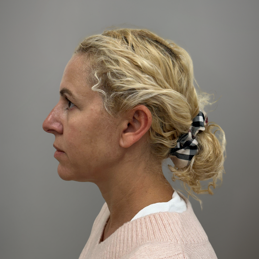 Профилен изглед на лице преди ринопластика, с изразен носен профил.