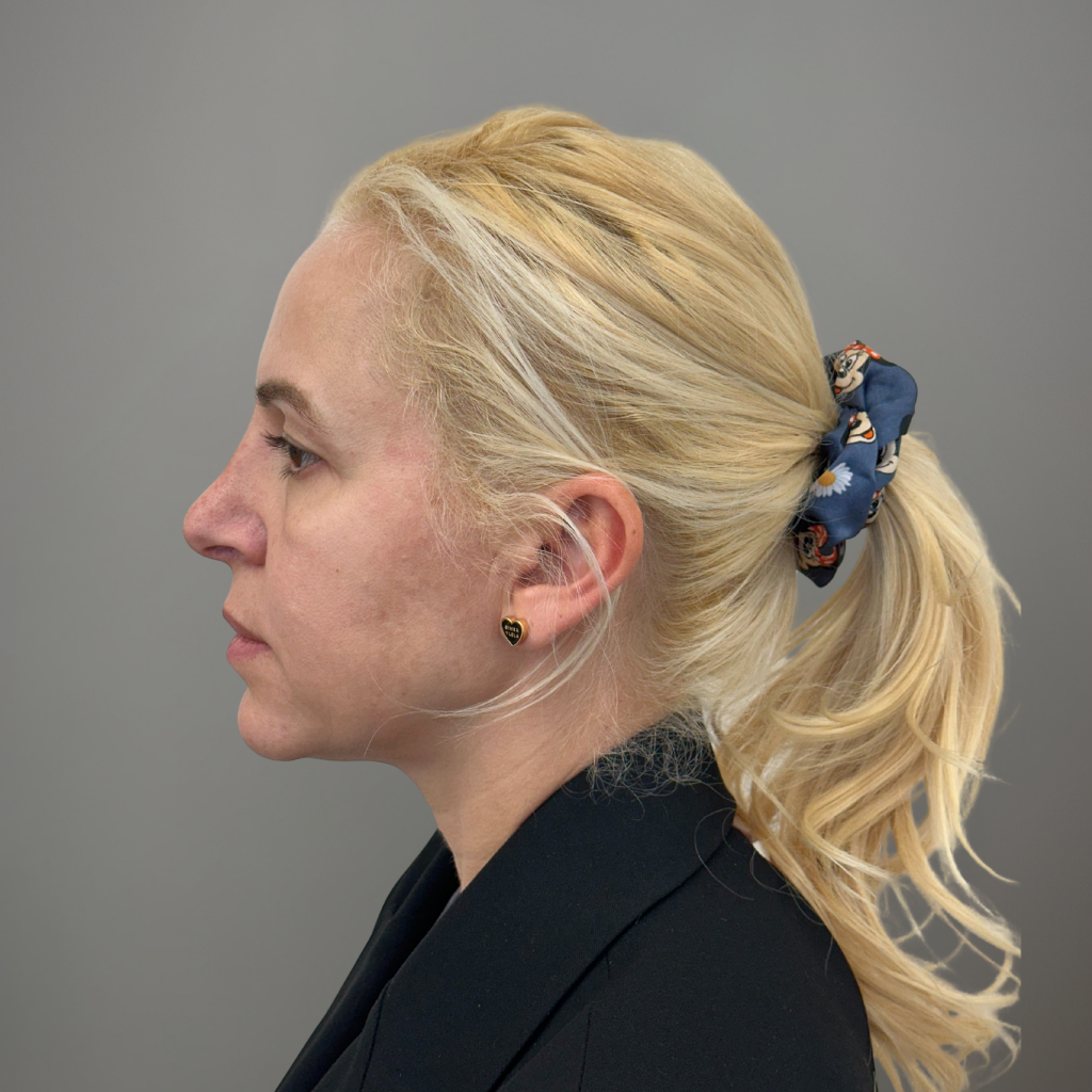 Профилен изглед на лице след ринопластика, с коригиран носен контур и естествен профилен резултат.