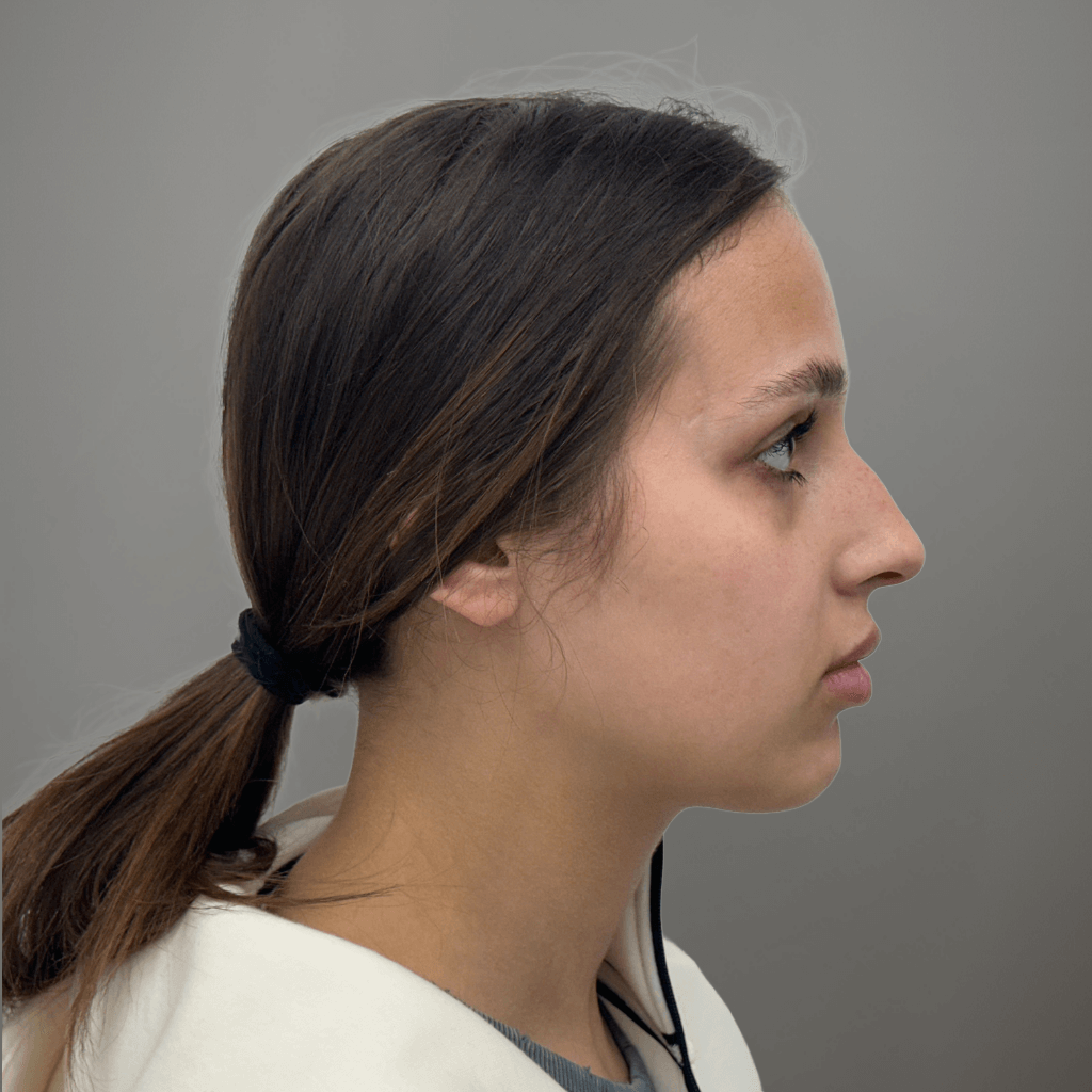 Профилна снимка отдясно на пациент след ринопластика, с подобрена симетрия и естествен резултат, постигнат в клиника Aesthetico