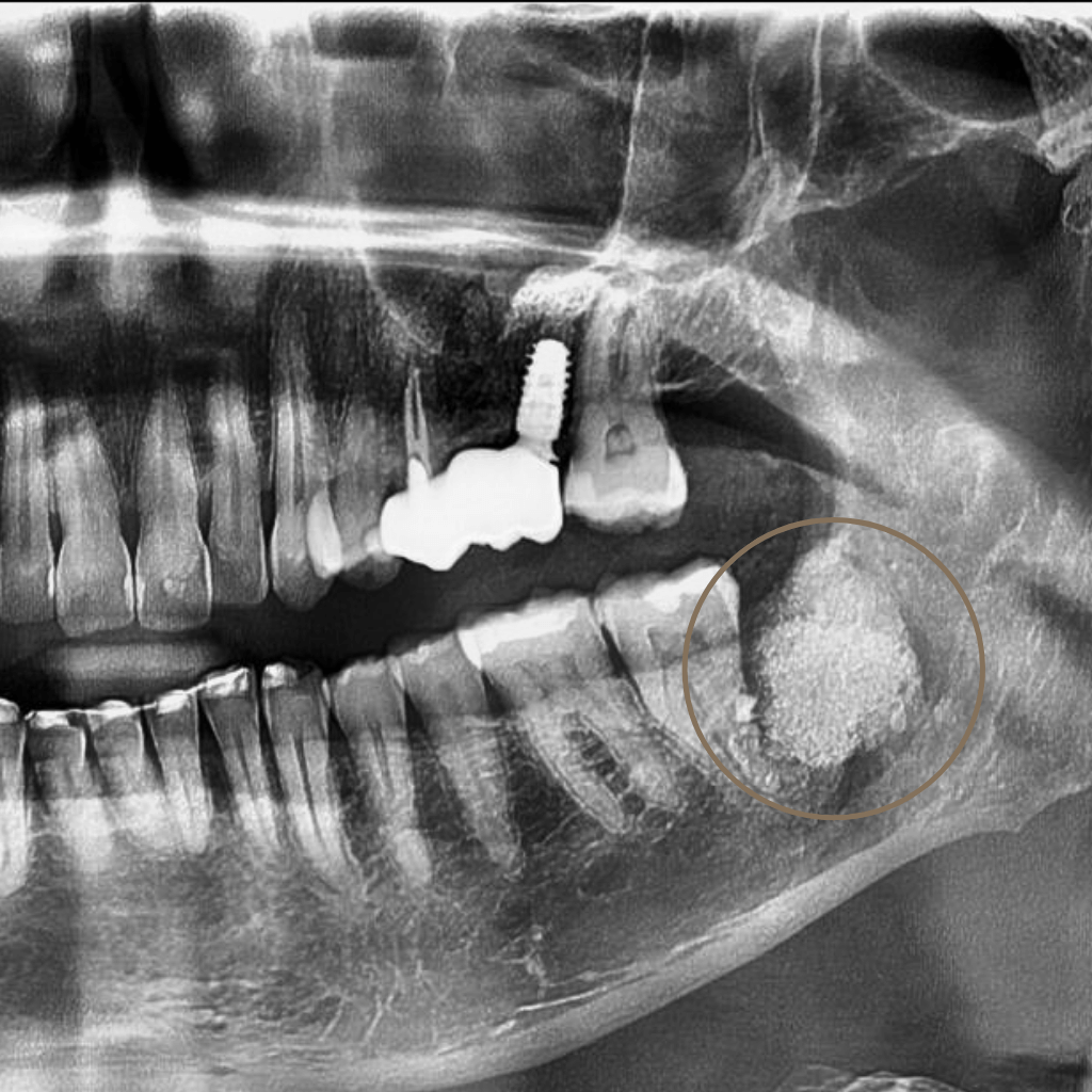 Панорамна рентгенография след хирургична екстракция на ретиниран мъдрец в долната челюст
