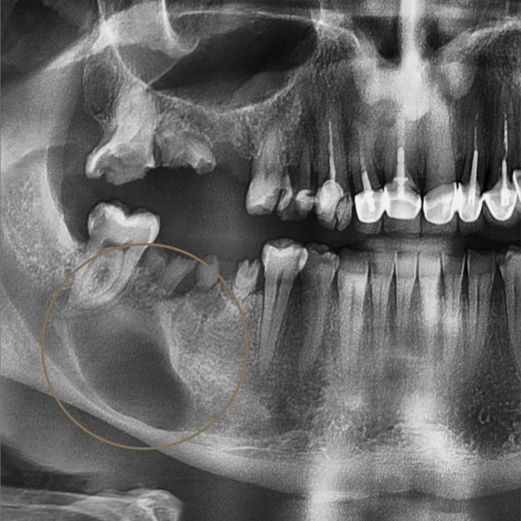Панорамна рентгенография (ОПГ), показваща голяма киста в областта на долната челюст