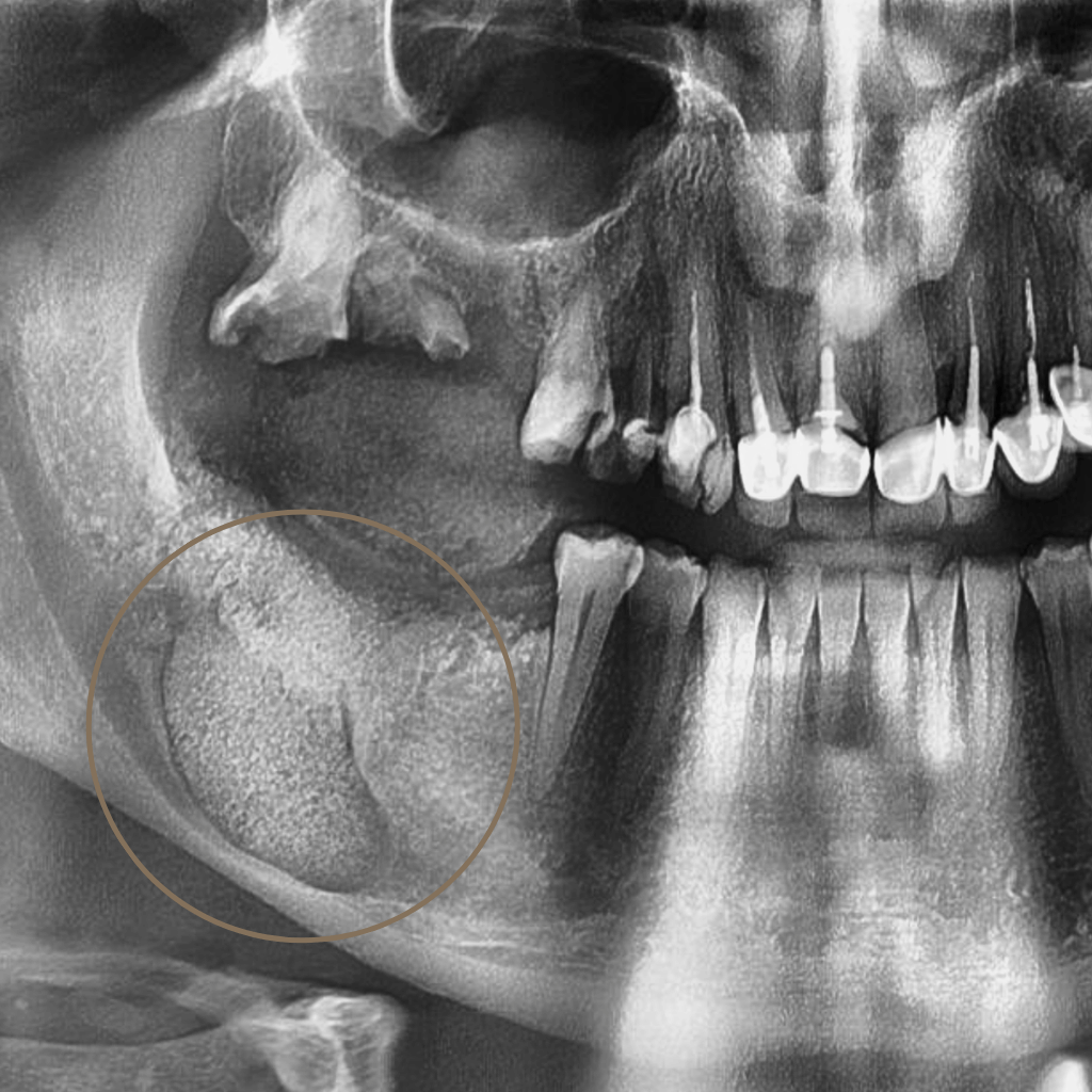 Панорамна рентгенография след хирургично отстраняване на киста в долната челюст