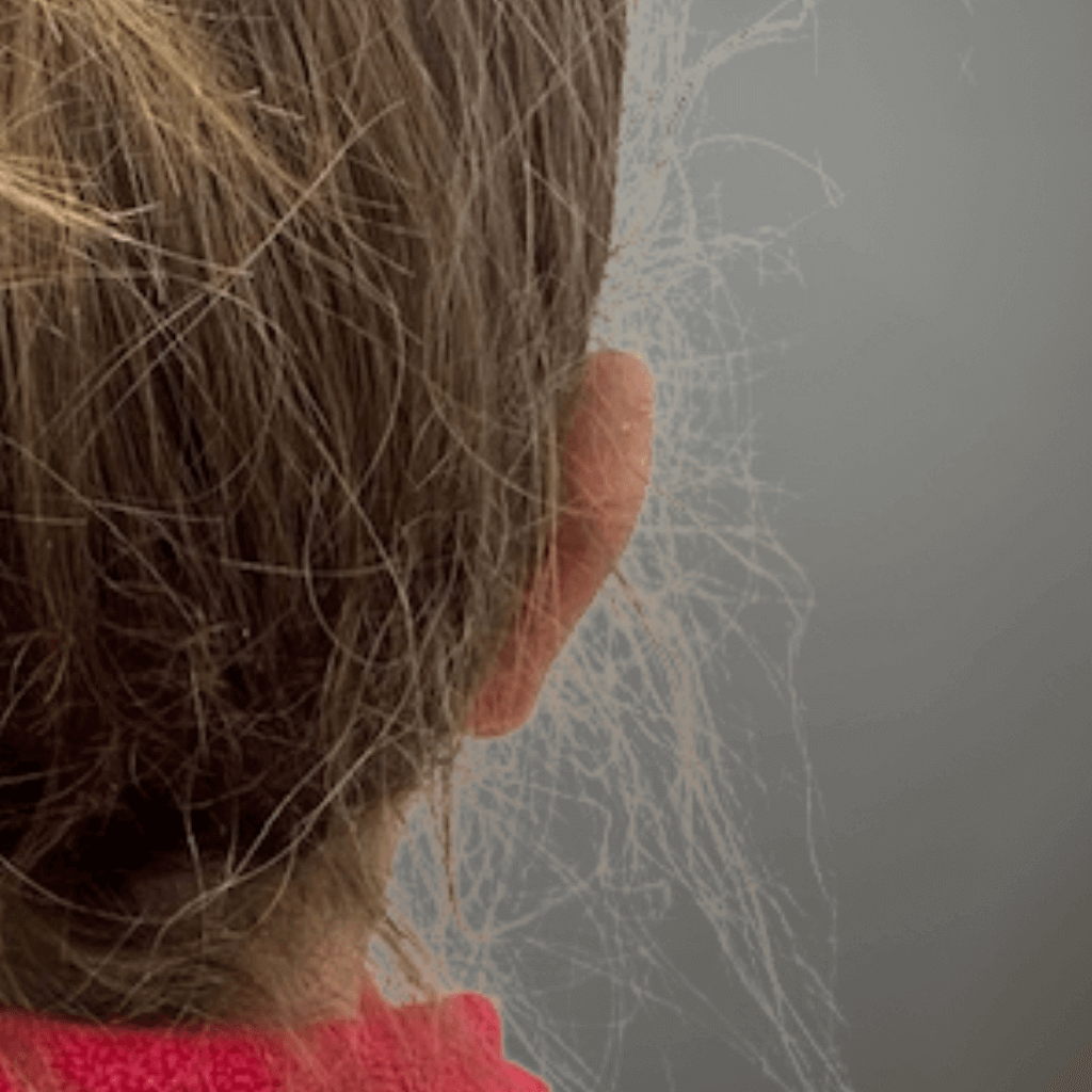 Резултат след отопластика при дете – позиция на дясното ухо след корекция на щръкнали уши