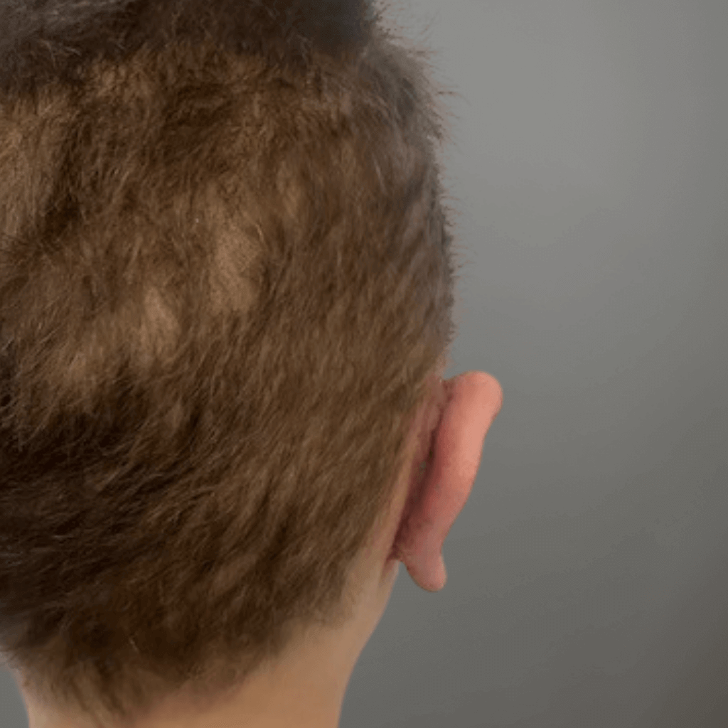 Постоперативен изглед на дясно ухо при дете със щръкнали уши след отопластика