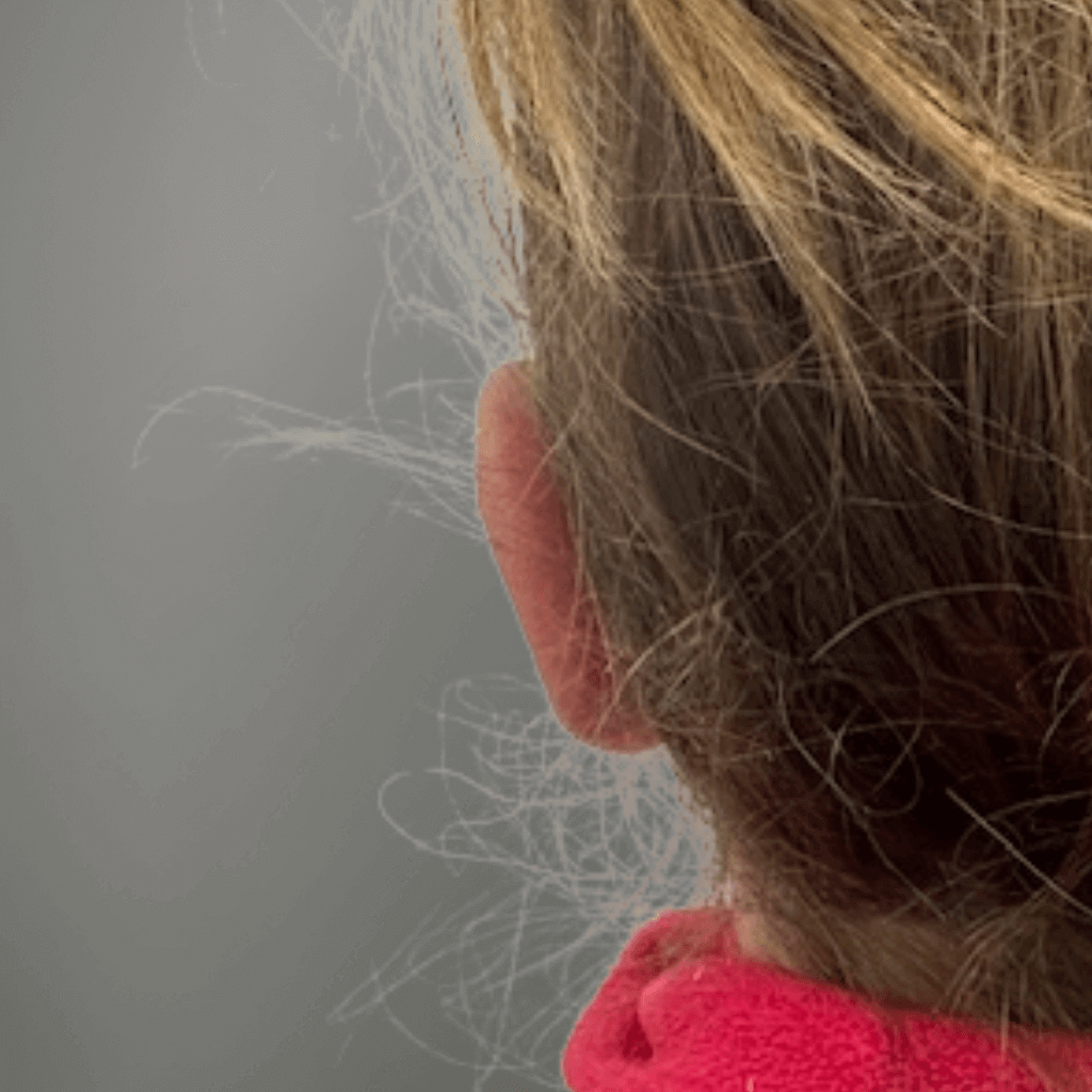 Резултат след отопластика при дете – позиция на ляво ухо след корекция на щръкнали уши