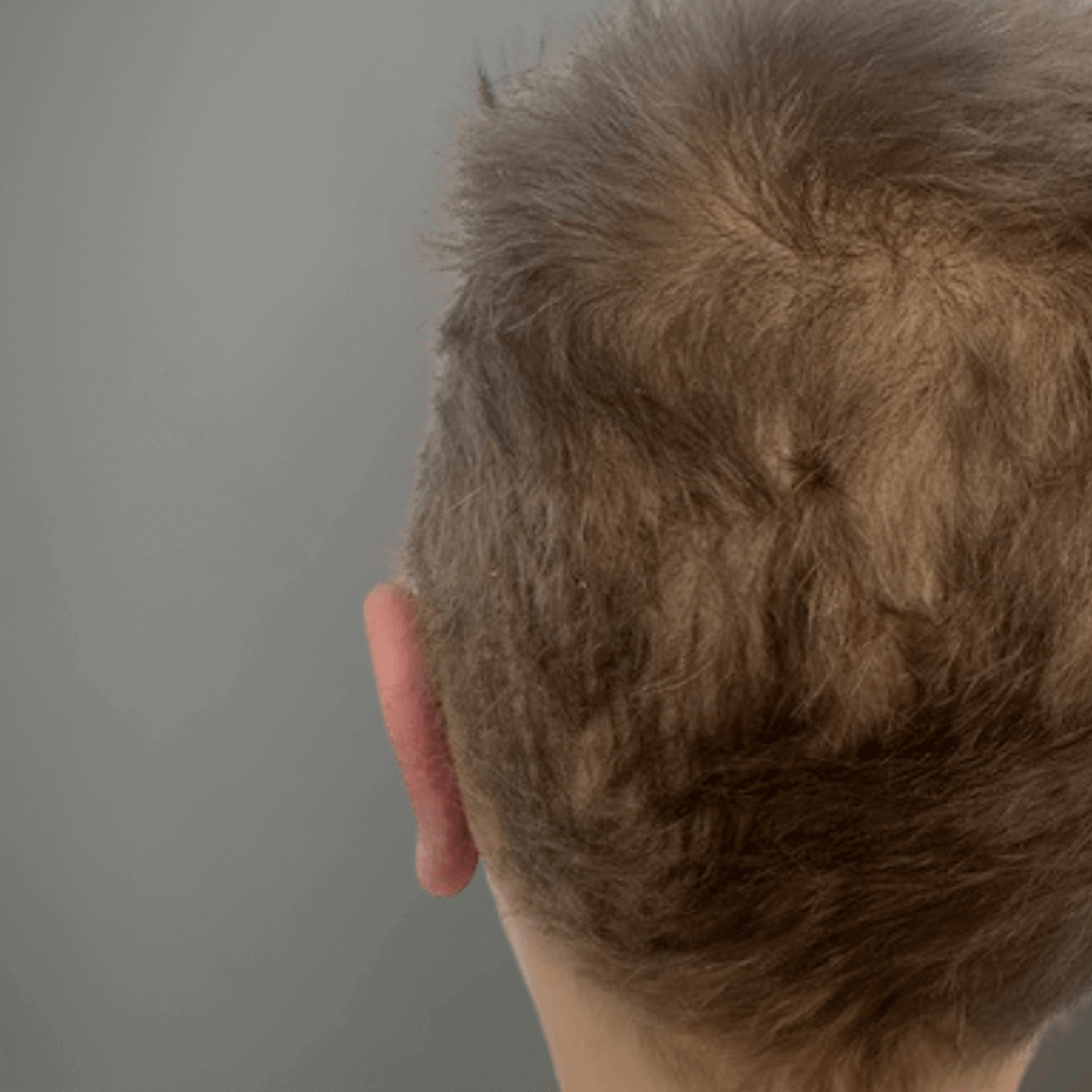 Постоперативен изглед на ляво ухо при дете със щръкнали уши след отопластика