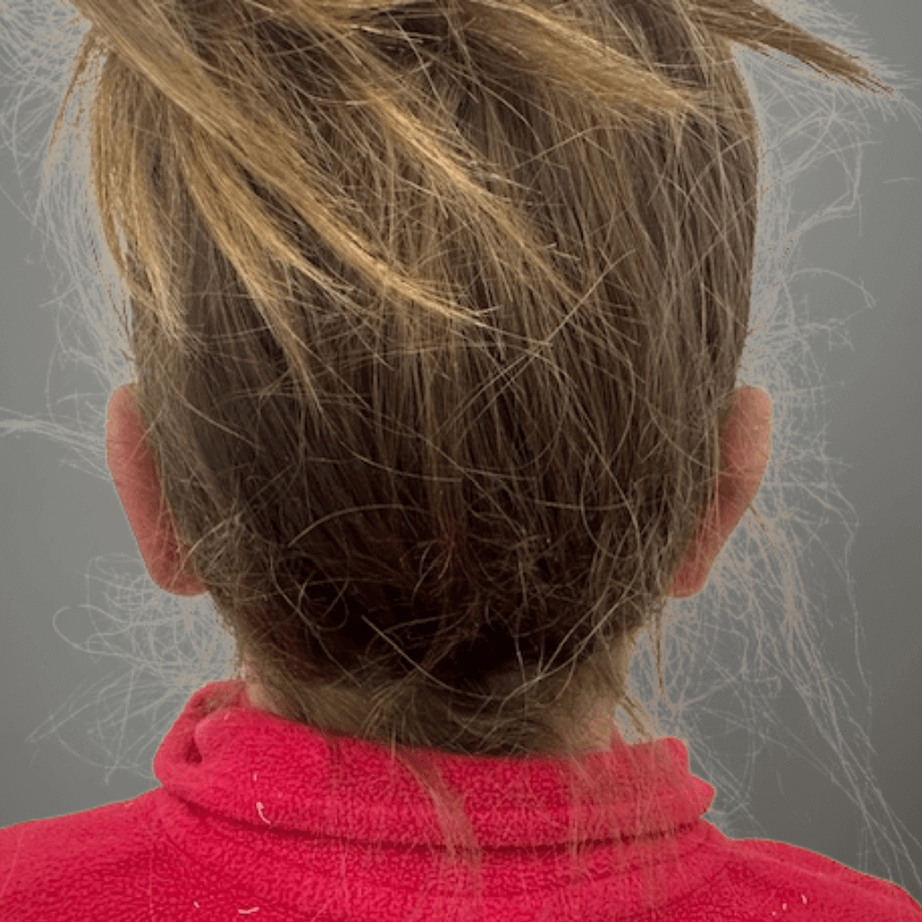 Изглед отзад на глава при дете след отопластика, показващ новата позиция на ушите