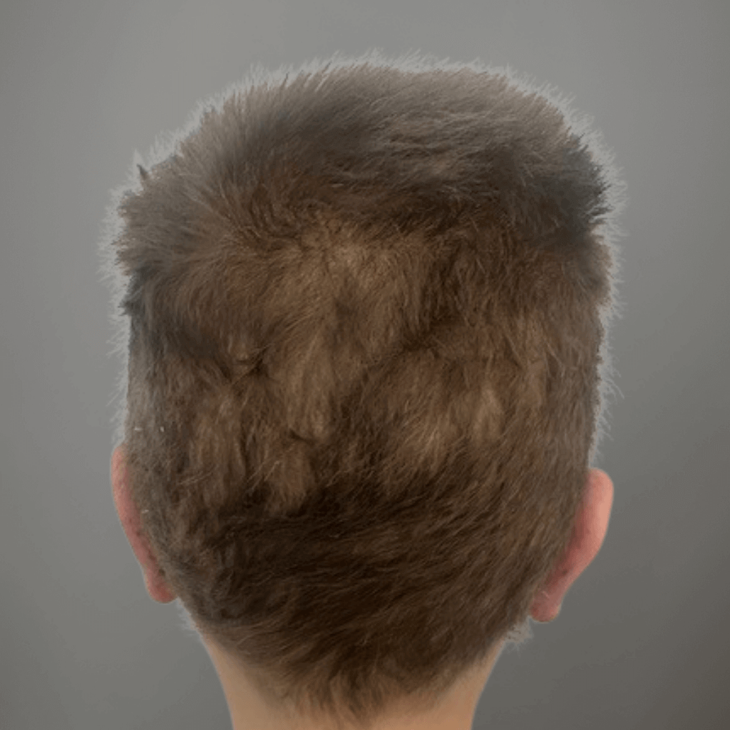 Постоперативен изглед отзад на глава при дете със щръкнали уши след корекция