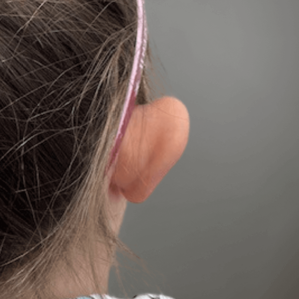 Детайлен изглед на дясното ухо преди отопластика при дете