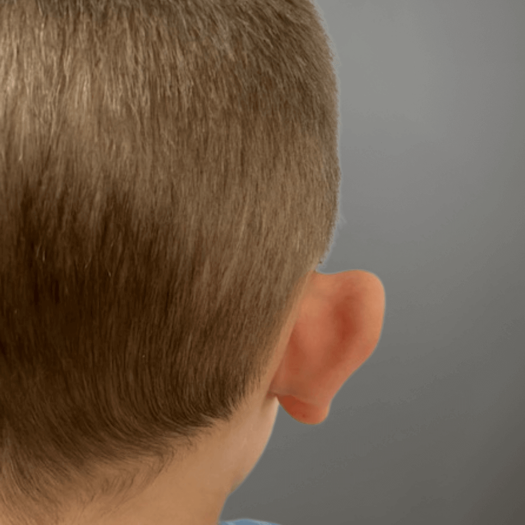 Предоперативен изглед на дясно ухо при дете със щръкнали уши преди отопластика