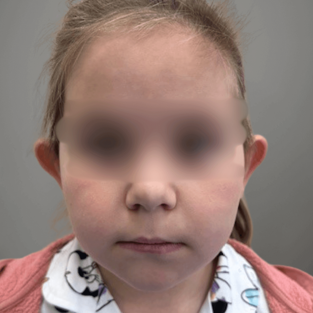 Фронтален изглед на дете преди корекция на щръкнали уши