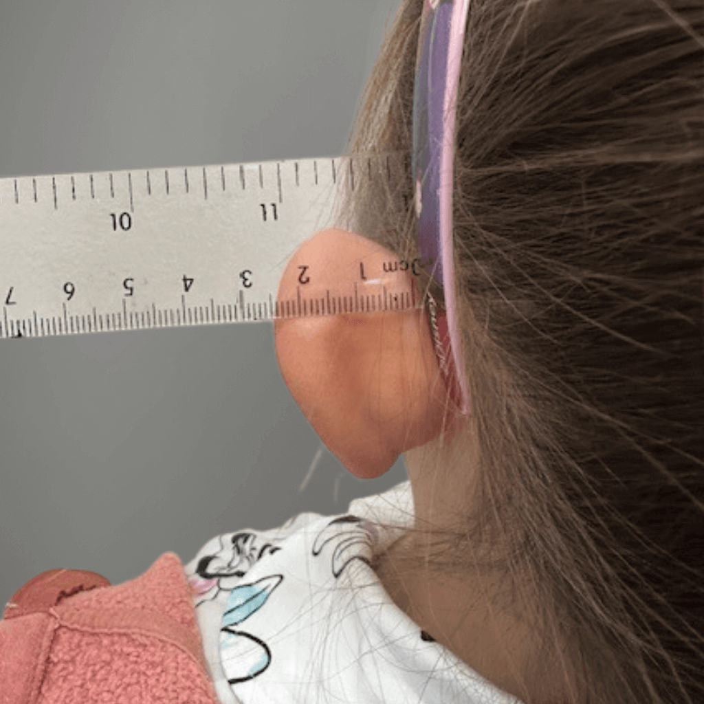 Детайлен изглед на ляво ухо преди отопластика при дете