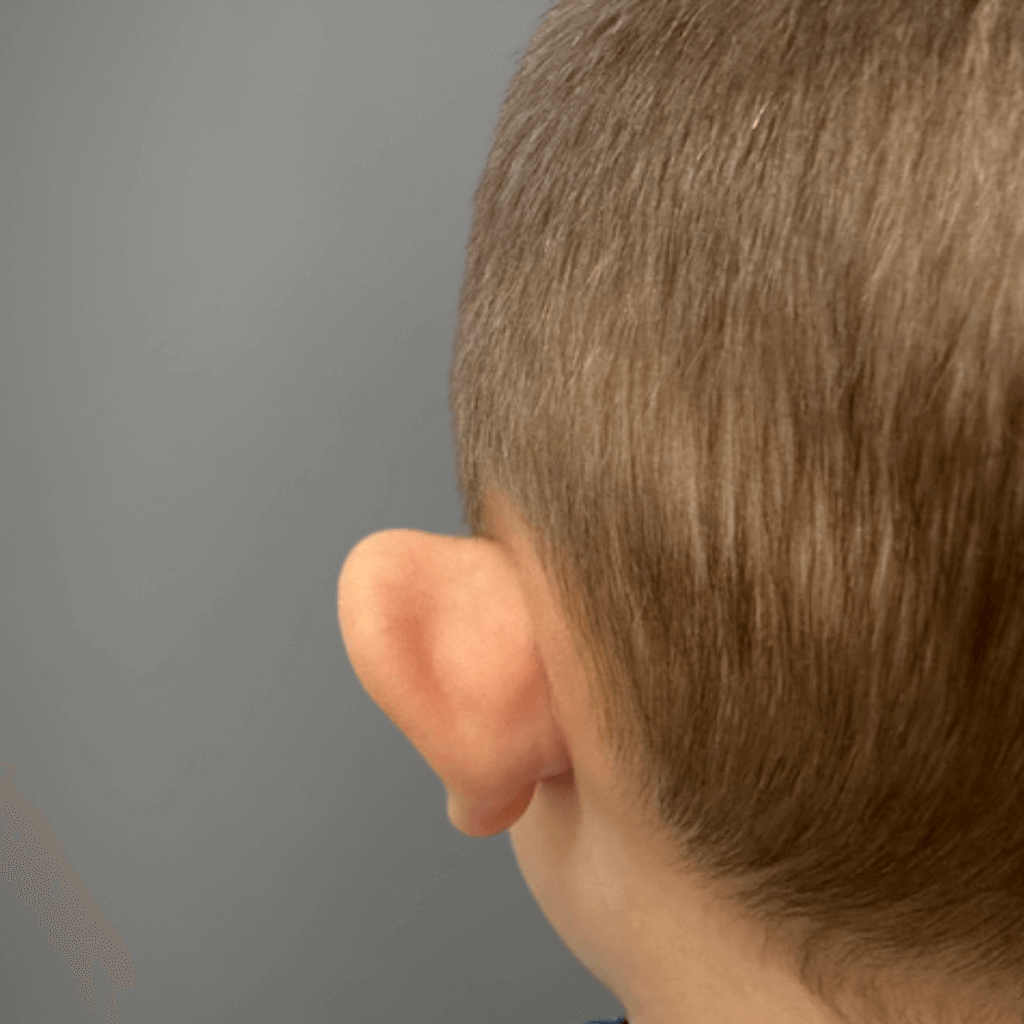 Предоперативен изглед на ляво ухо при дете със щръкнали уши преди отопластика