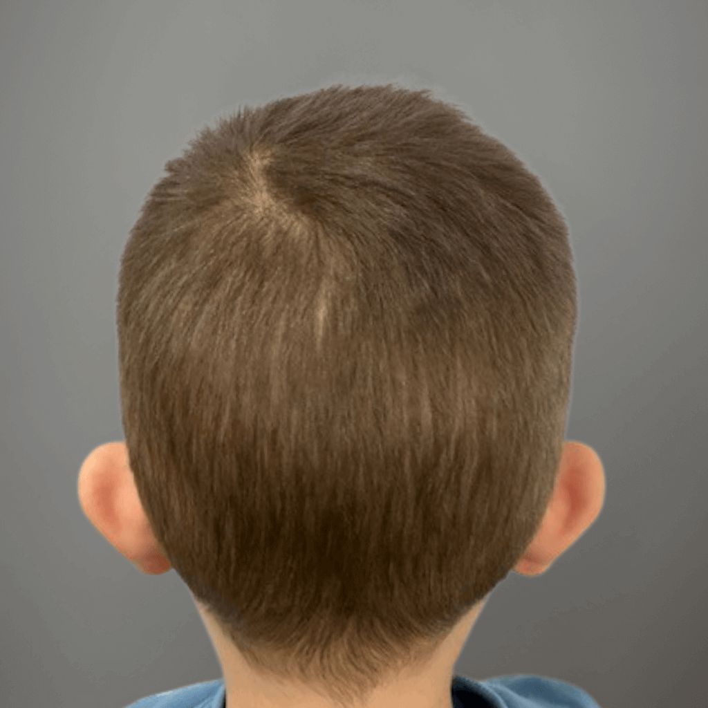 Предоперативен изглед отзад на глава при дете със щръкнали уши преди корекция