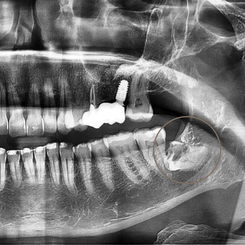 Панорамна рентгенография (ОПГ), показваща ретиниран мъдрец в долната челюст преди хирургична екстракция