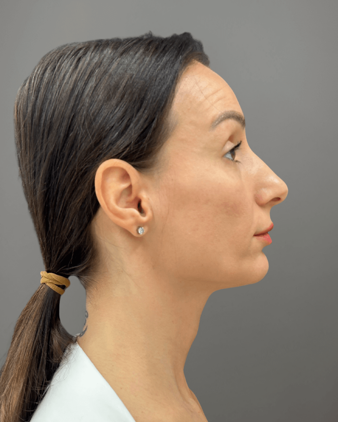 Десен профил преди ринопластика