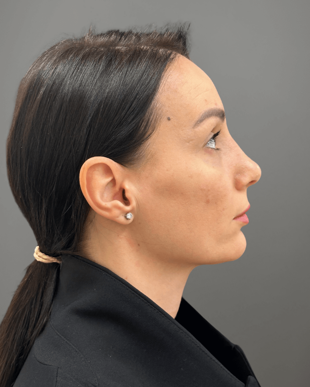 Десен профил след ринопластика – резултат от операция на носа