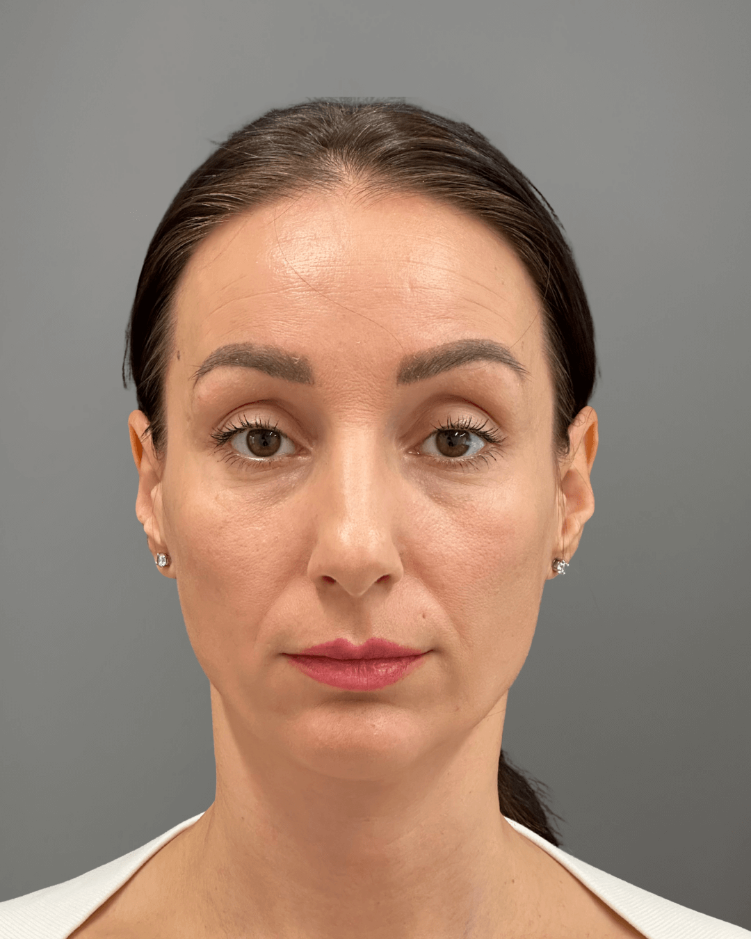 Фронтален изглед преди ринопластика