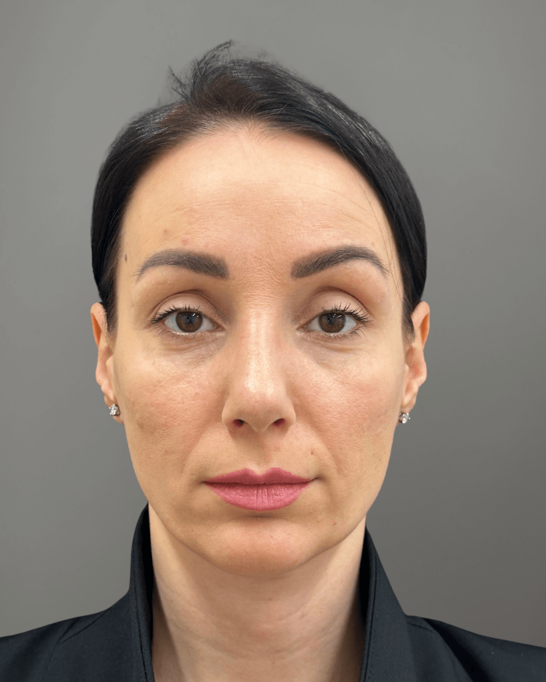 Фронтален изглед след ринопластика