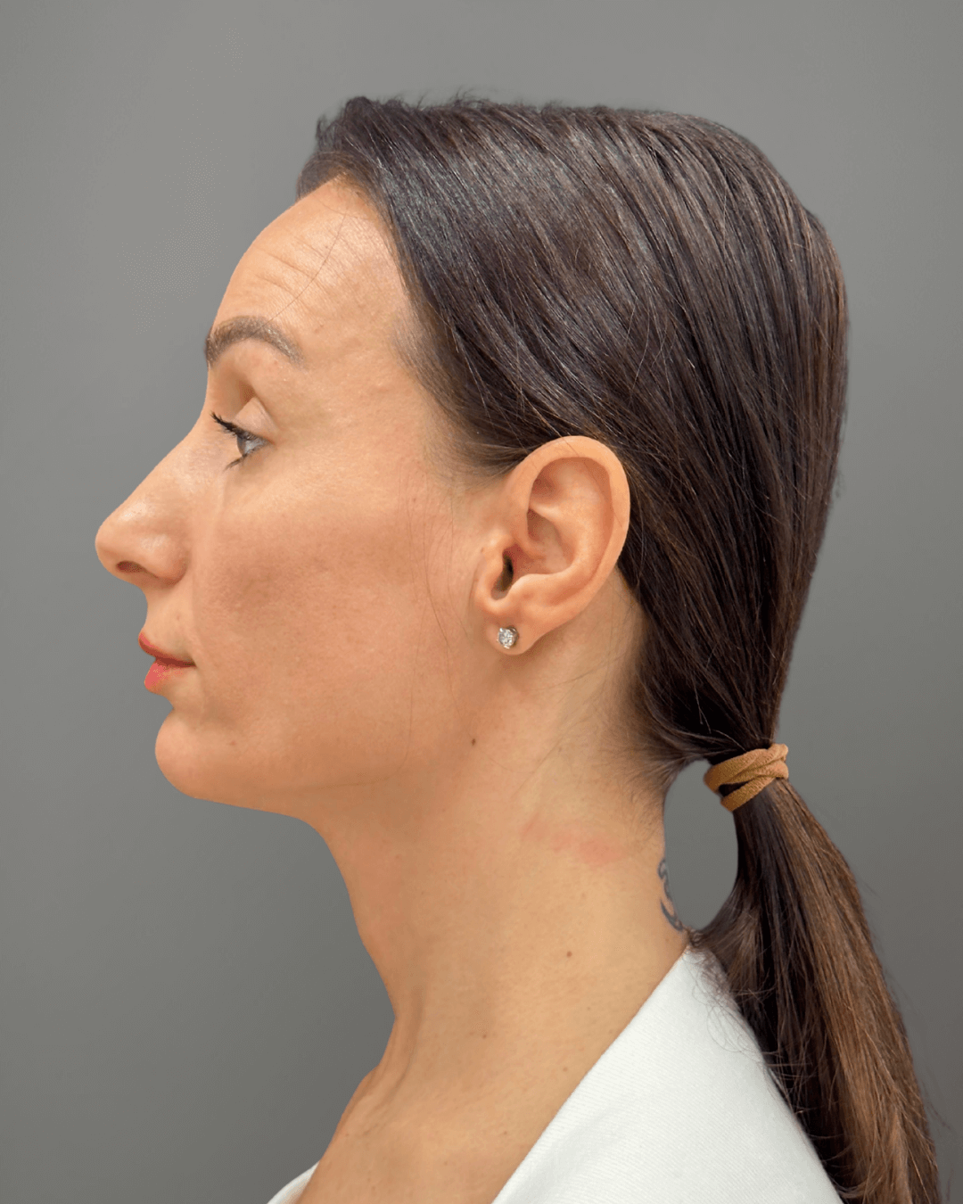 Ляв профил преди ринопластика – предоперативен изглед на носа