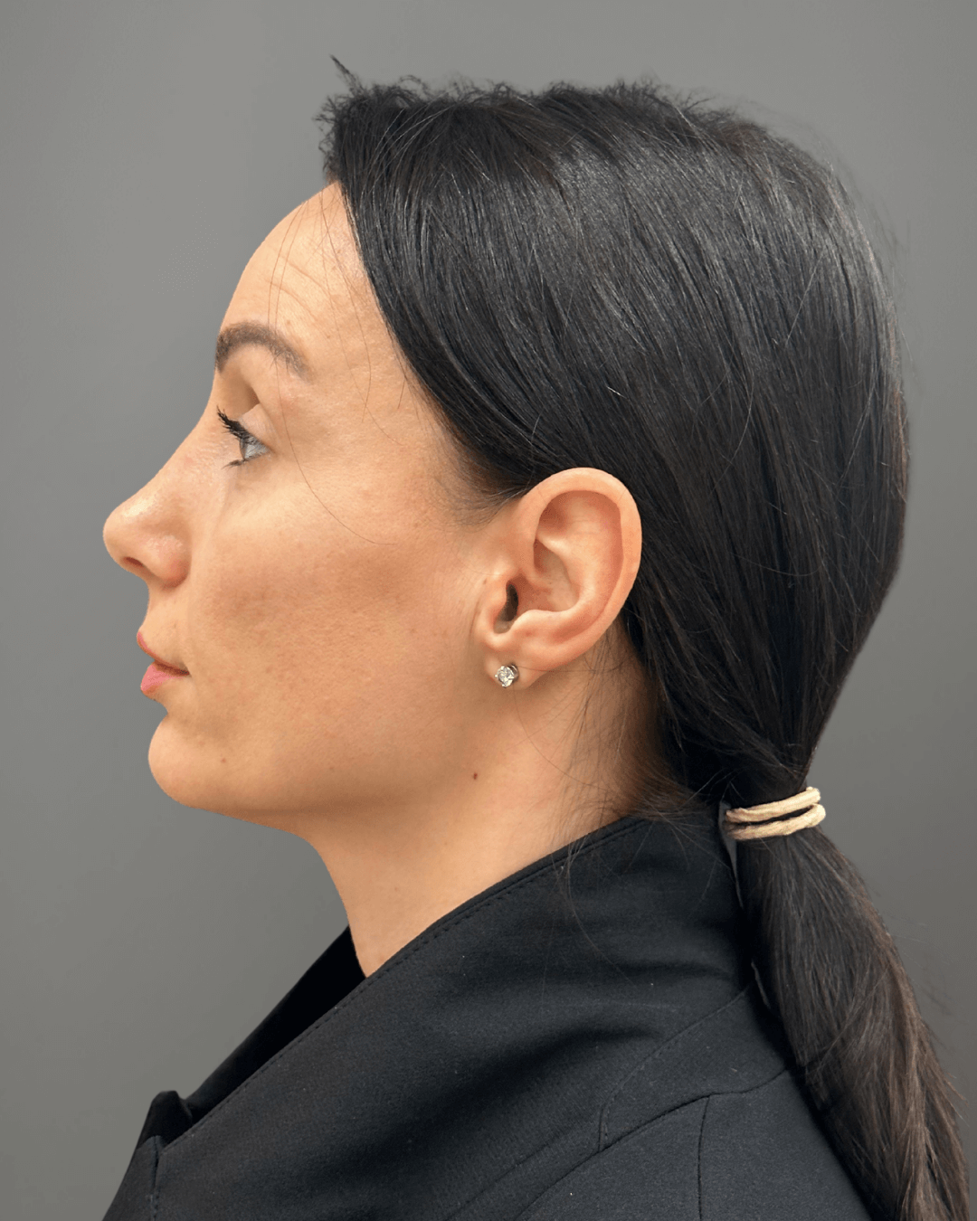 Ляв профил след ринопластика – резултат след операция на носа