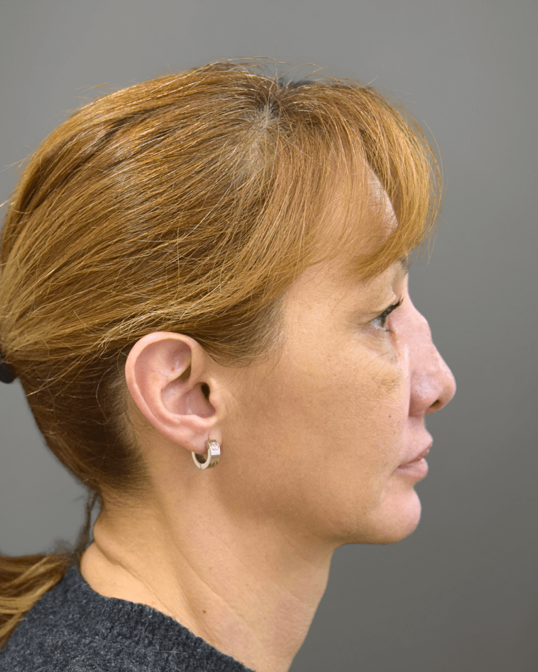 Десен профил преди ринопластика