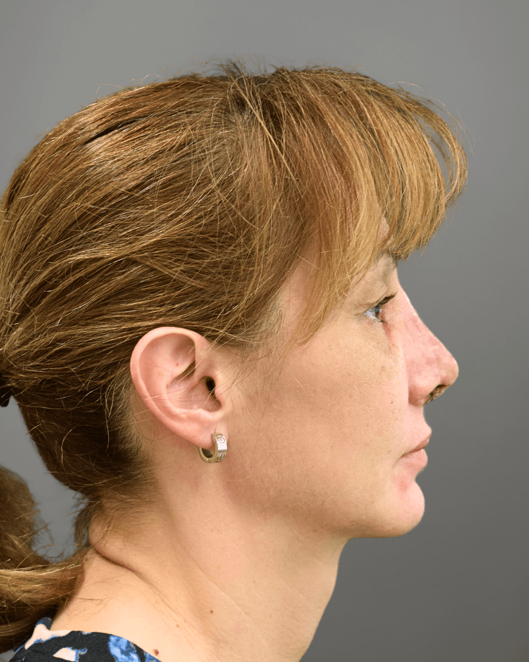 Десен профил след ринопластика – резултат от операция на носа