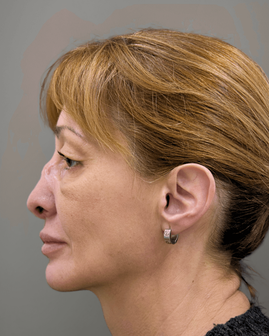 Ляв профил преди ринопластика – предоперативен изглед на носа