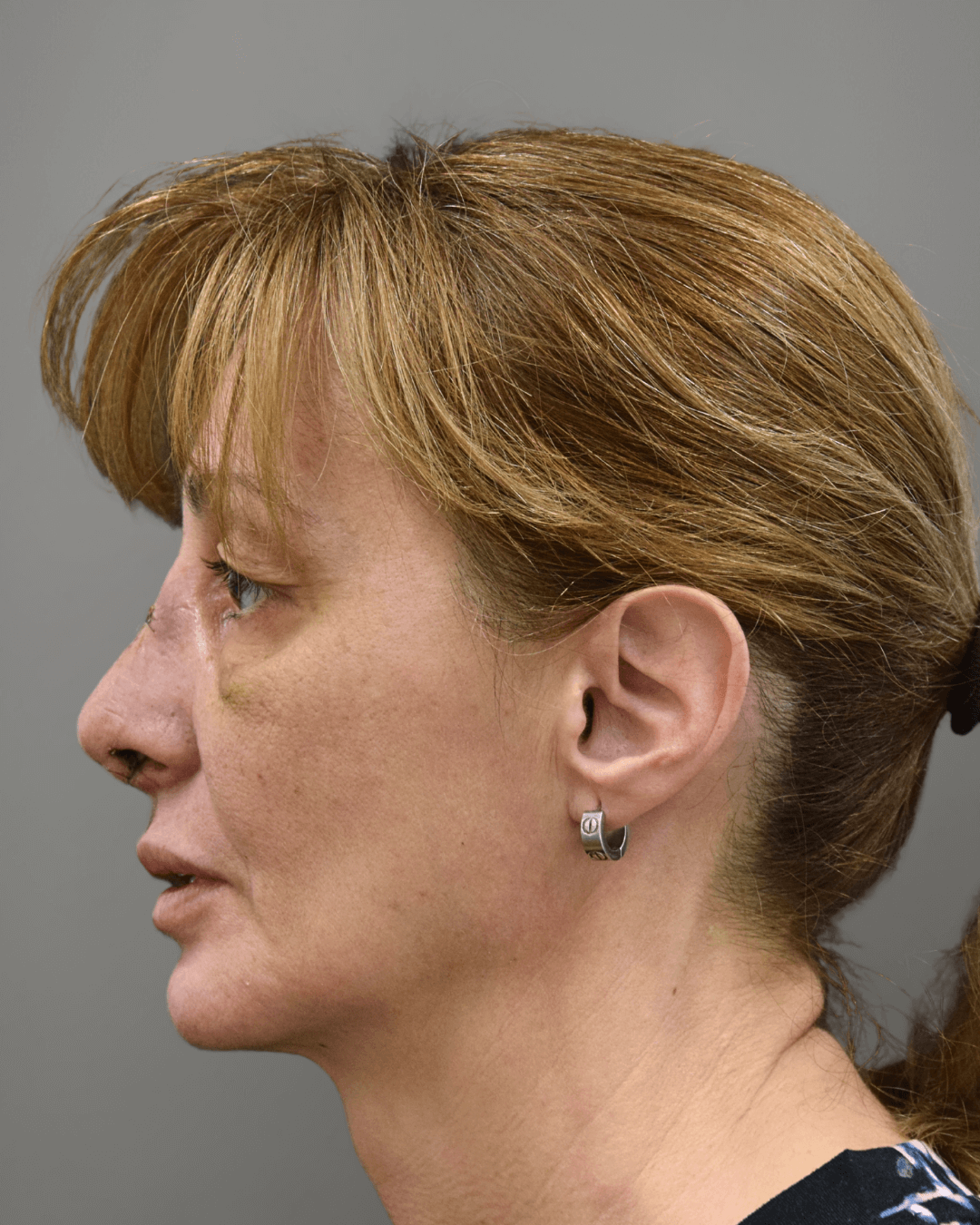 Ляв профил след ринопластика – резултат след операция на носа