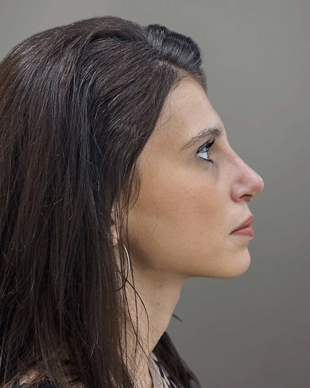 Десен профил след ринопластика – резултат от операция на носа