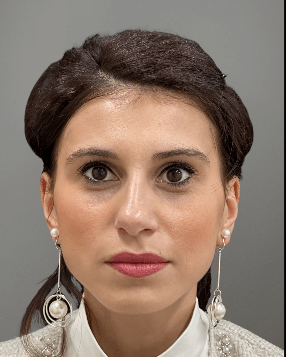 Фронтален изглед преди ринопластика