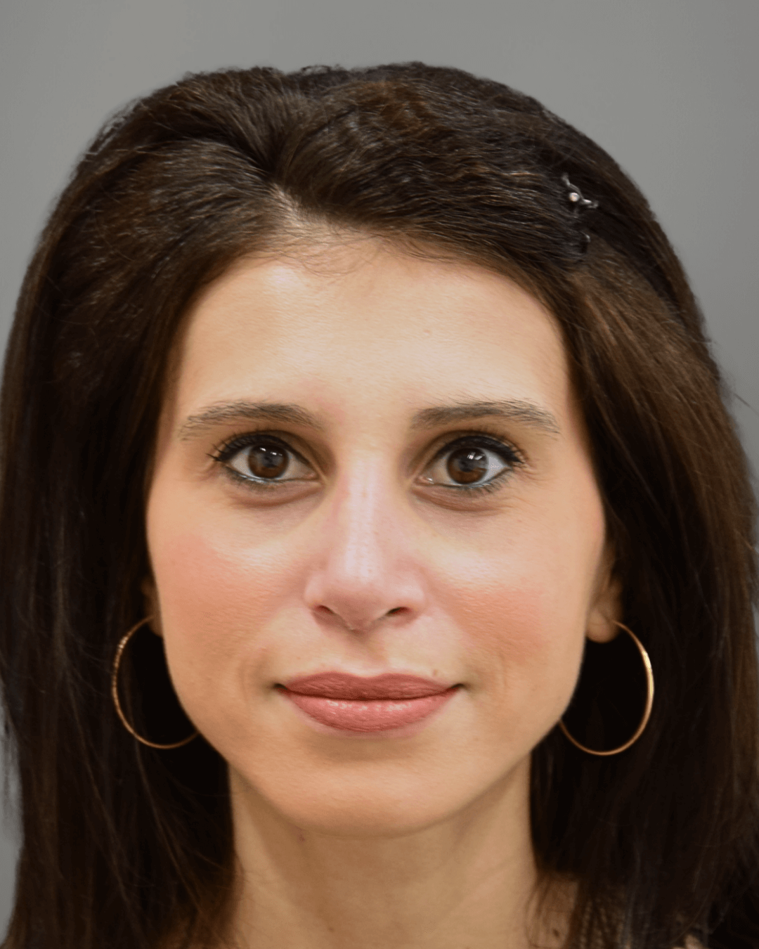 Фронтален изглед след ринопластика