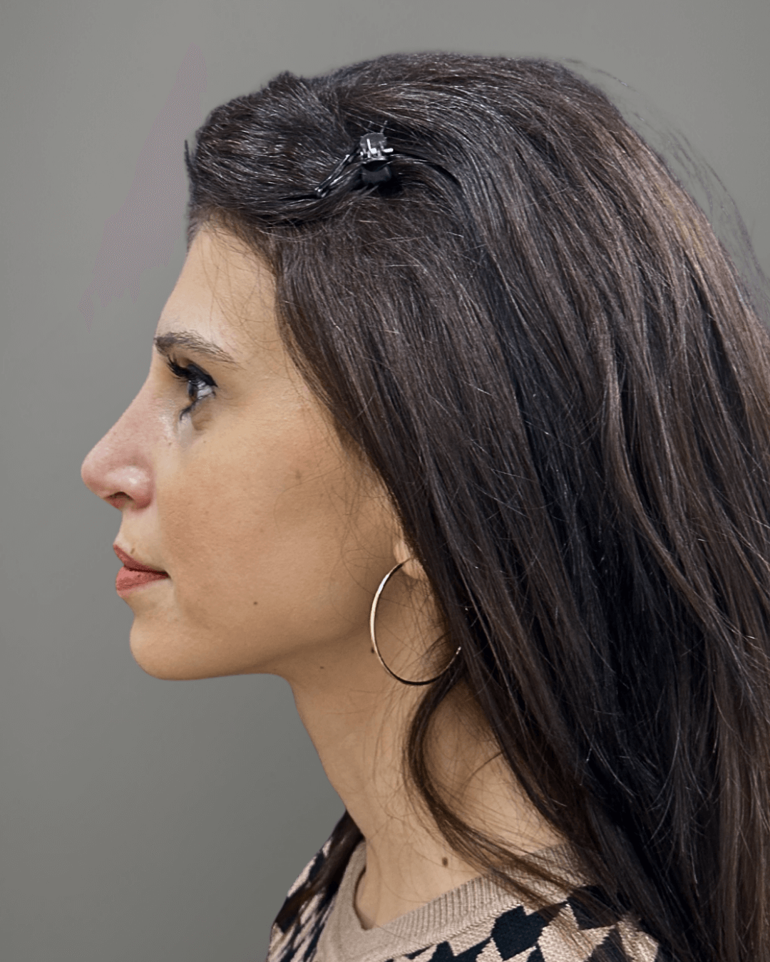 Ляв профил след ринопластика – резултат след операция на носа