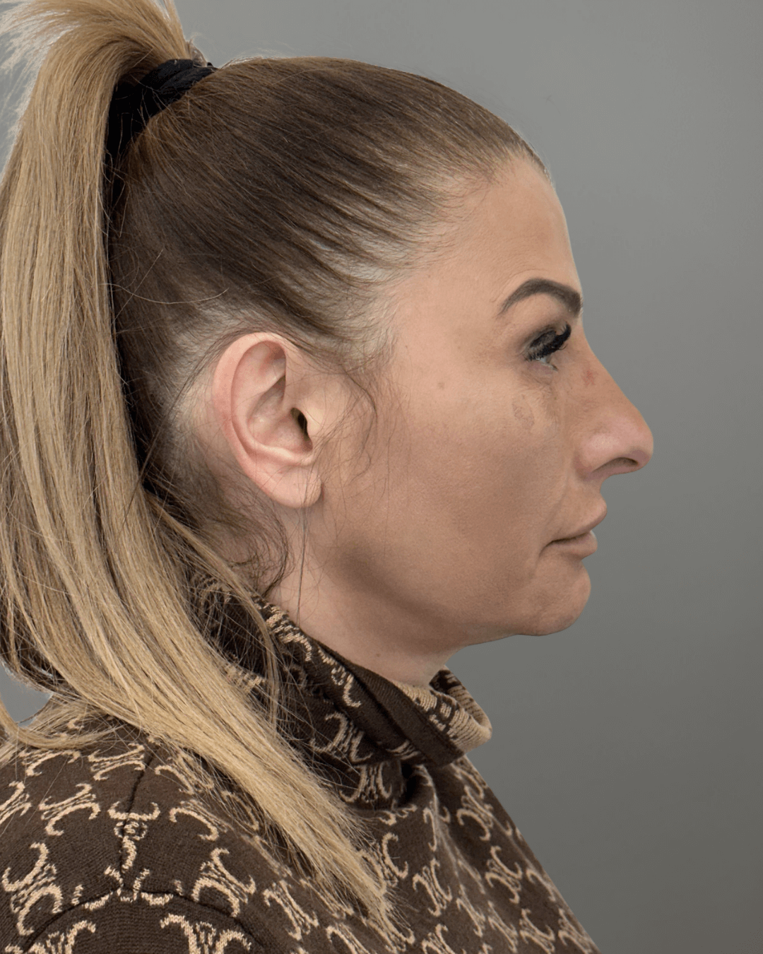 Десен профил преди ринопластика