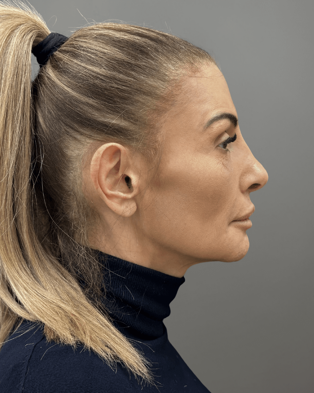 Десен профил след ринопластика – резултат от операция на носа