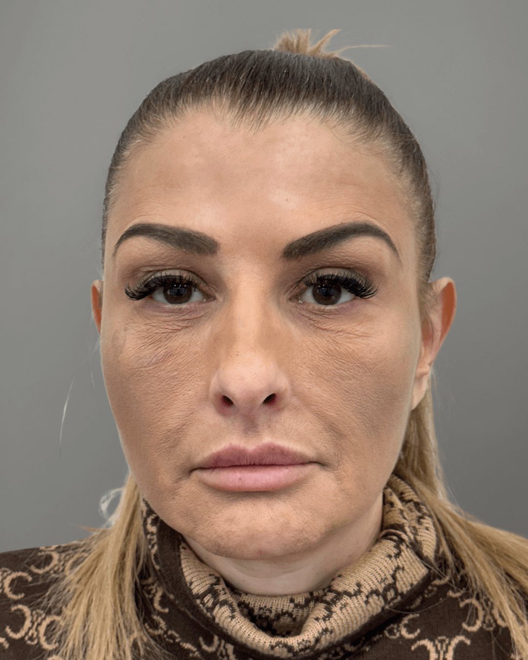 Фронтален изглед преди ринопластика