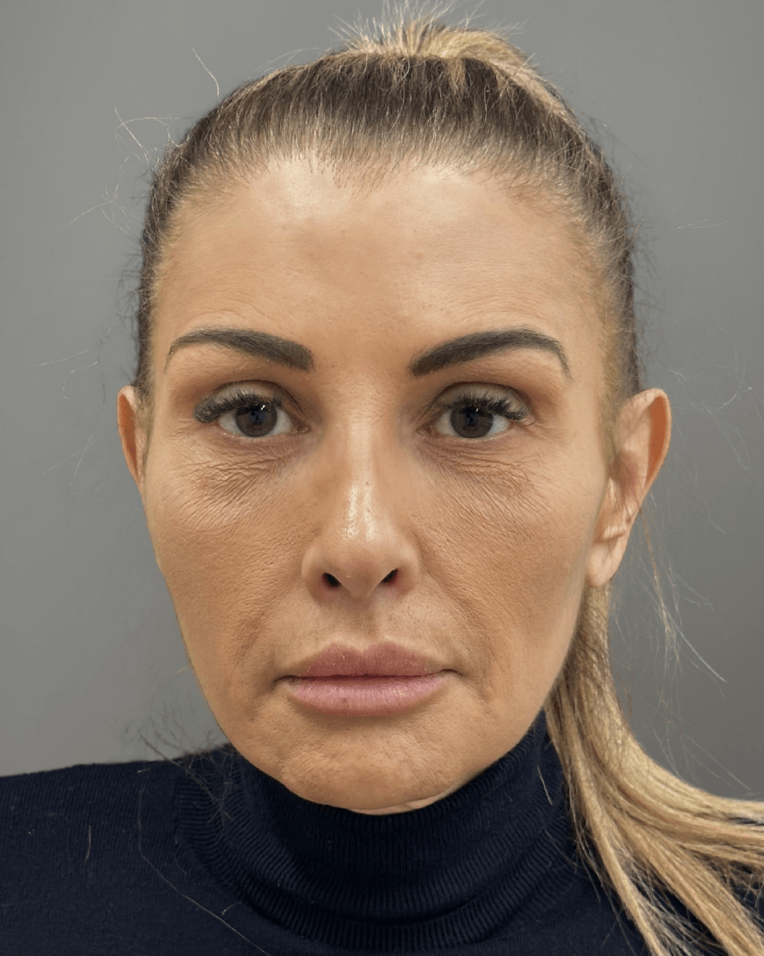 Фронтален изглед след ринопластика