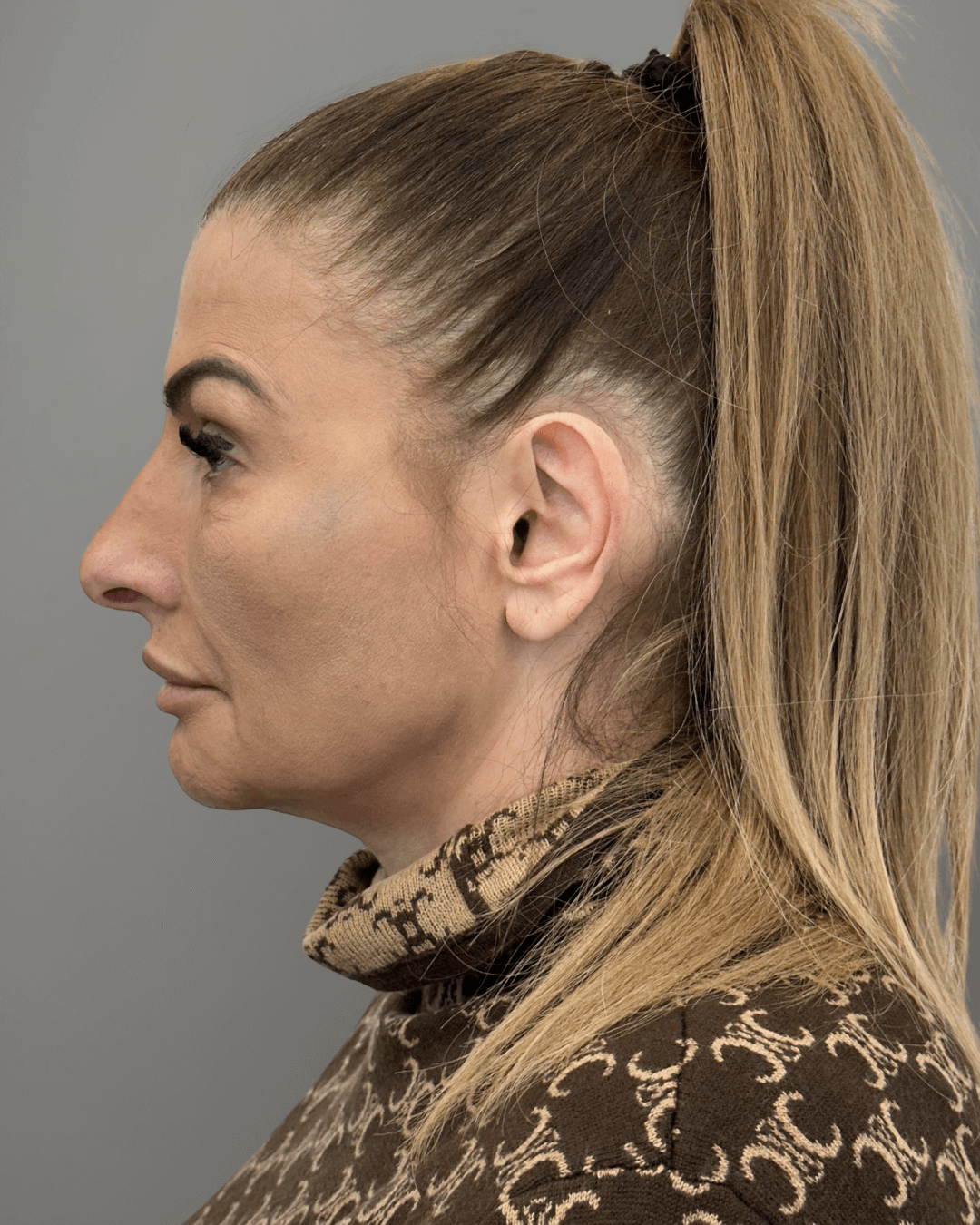 Ляв профил преди ринопластика – предоперативен изглед на носа